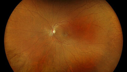 microscopique image of a retina during a retinal scan