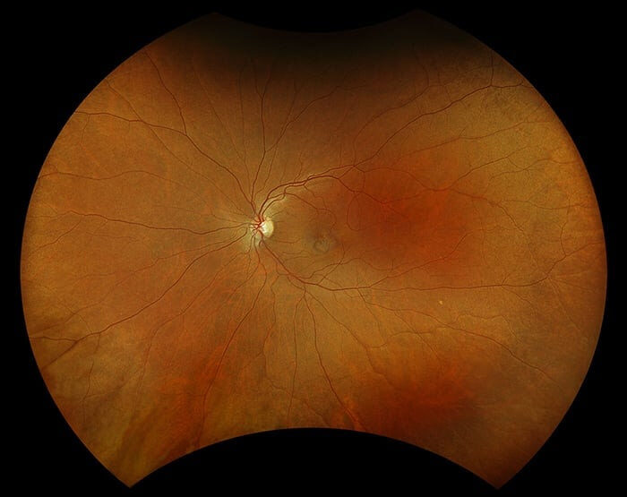 microscopique image of a retina during a retinal scan